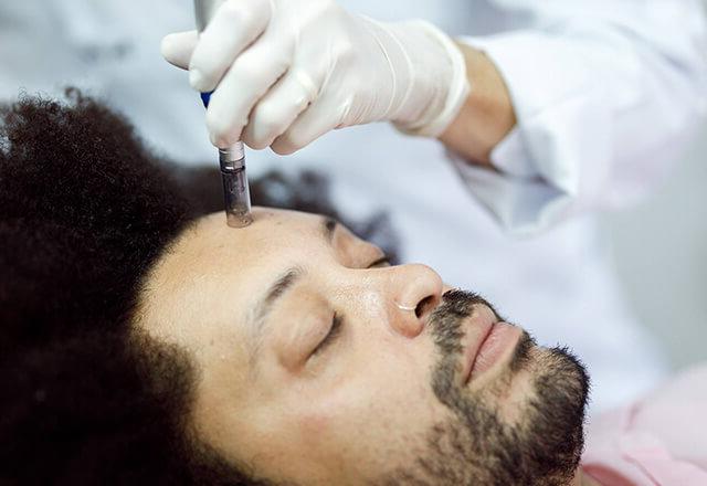 A man receives microneedling treatment on his face.